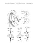 DEVICES AND METHODS FOR REDUCING CARDIAC VALVE REGURGITATION diagram and image