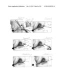 IMPLANTATION OF MICRONIZED ALLOGRAFT TISSUE OVER A MICROFRACTURED DEFECT diagram and image