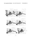 IMPLANTATION OF MICRONIZED ALLOGRAFT TISSUE OVER A MICROFRACTURED DEFECT diagram and image