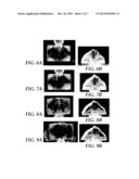 ULTRASONIC-ASSISTED MOLDING OF PRECISELY-SHAPED ARTICLES AND METHODS diagram and image