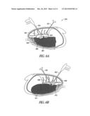 SYSTEM AND METHOD FOR BRONCHIAL DILATION diagram and image