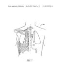 SYSTEM AND METHOD FOR BRONCHIAL DILATION diagram and image