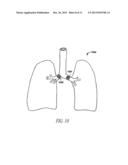 SYSTEM AND METHOD FOR BRONCHIAL DILATION diagram and image