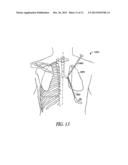 SYSTEM AND METHOD FOR BRONCHIAL DILATION diagram and image