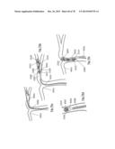 CLOT RETRIEVAL DEVICE FOR REMOVING OCCLUSIVE CLOT FROM A BLOOD VESSEL diagram and image