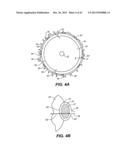 INTRAOCULAR IMPLANTS AND RELATED KITS AND METHODS diagram and image