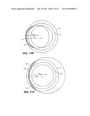 INTRAOCULAR IMPLANTS AND RELATED KITS AND METHODS diagram and image