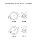 INTRAOCULAR IMPLANTS AND RELATED KITS AND METHODS diagram and image