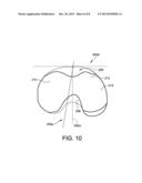 KNEE IMPLANT SYSTEM diagram and image