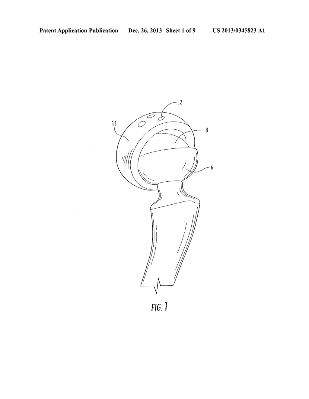 Interlocking Reverse Hip Revision Prosthesis and Method - diagram, schematic, and image 02