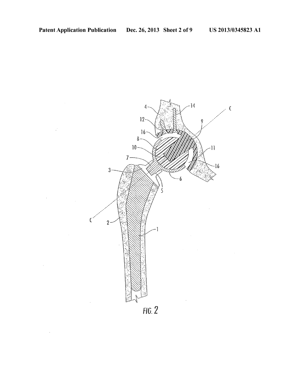 Interlocking Reverse Hip Revision Prosthesis and Method - diagram, schematic, and image 03