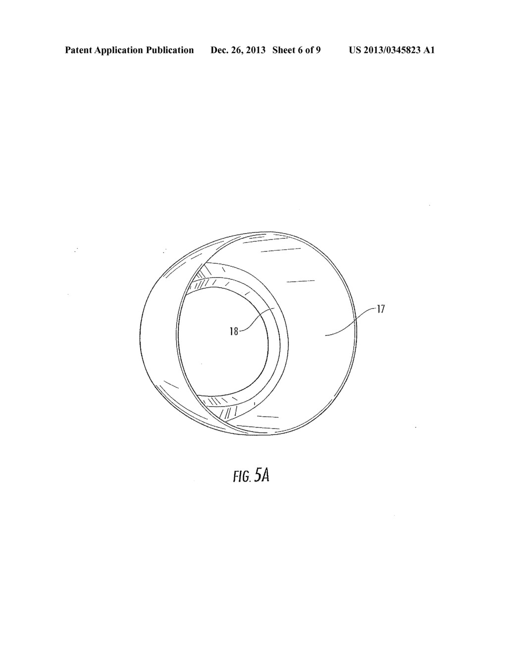 Interlocking Reverse Hip Revision Prosthesis and Method - diagram, schematic, and image 07