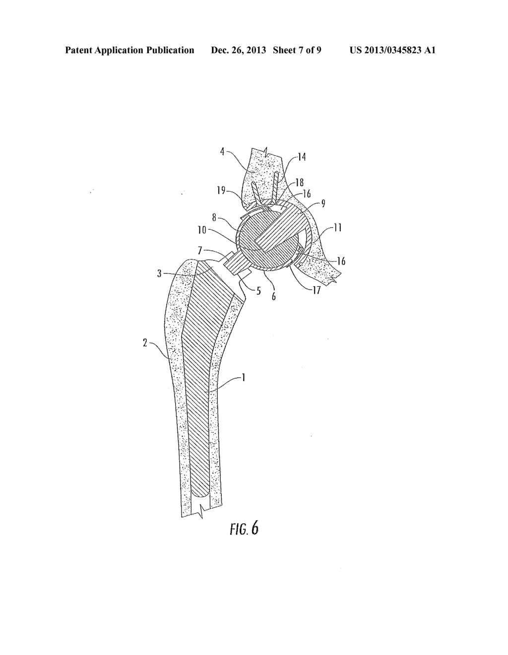 Interlocking Reverse Hip Revision Prosthesis and Method - diagram, schematic, and image 08