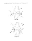 ARTHROPLASTY SYSTEM AND RELATED METHODS diagram and image