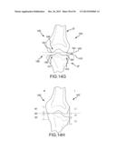 ARTHROPLASTY SYSTEM AND RELATED METHODS diagram and image