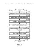 Laser Nil Liposuction System and Method diagram and image