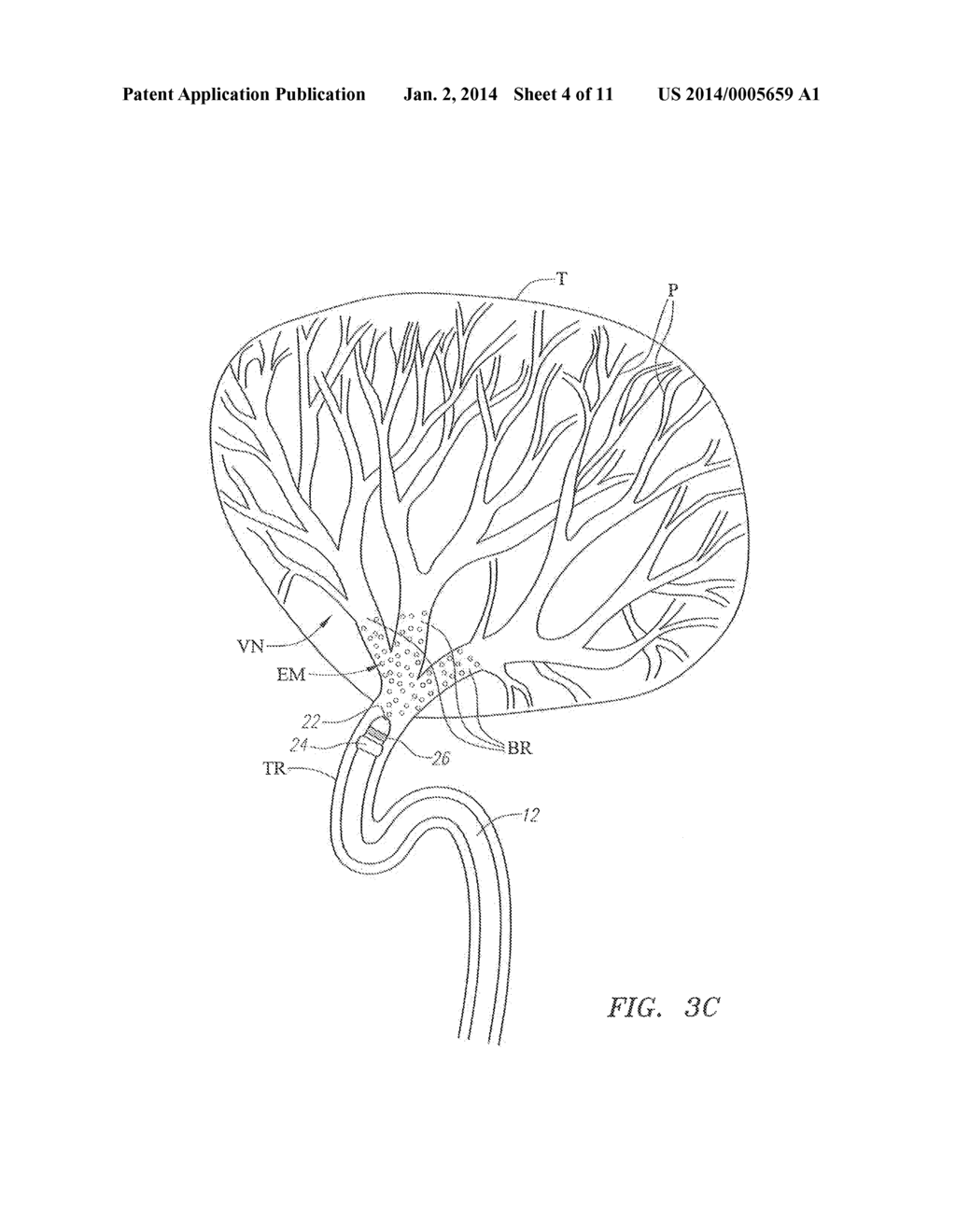 Method of Treating Tissue with Radio Frequency Vascular Electrode Array - diagram, schematic, and image 05