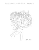 Method of Treating Tissue with Radio Frequency Vascular Electrode Array diagram and image