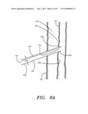 METHODS OF USE OF A CLIP APPLIER diagram and image