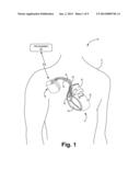 CRITERIA FOR OPTIMAL ELECTRICAL RESYNCHRONIZATION DURING BIVENTRICULAR     PACING diagram and image