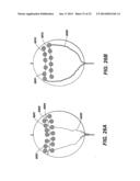 CATHETER BALLOON EMPLOYING FORCE SENSING ELEMENTS diagram and image