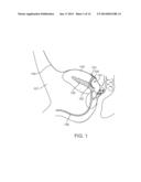 PERITONEAL DRAIN AND INFUSION diagram and image