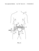 PERITONEAL DRAIN AND INFUSION diagram and image