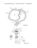 PERITONEAL DRAIN AND INFUSION diagram and image