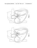 Devices and Methods of Treating Or Ameliorating Diastolic Heart Failure     through Pulmonary Valve Intervention diagram and image