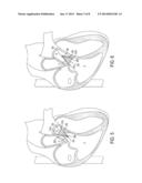 Devices and Methods of Treating Or Ameliorating Diastolic Heart Failure     through Pulmonary Valve Intervention diagram and image