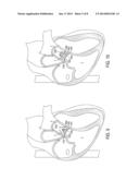 Devices and Methods of Treating Or Ameliorating Diastolic Heart Failure     through Pulmonary Valve Intervention diagram and image