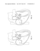 Devices and Methods of Treating Or Ameliorating Diastolic Heart Failure     through Pulmonary Valve Intervention diagram and image