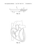 Devices and Methods of Treating Or Ameliorating Diastolic Heart Failure     through Pulmonary Valve Intervention diagram and image