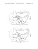 Devices and Methods of Treating Or Ameliorating Diastolic Heart Failure     through Pulmonary Valve Intervention diagram and image