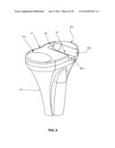 SYSTEM AND METHOD FOR JOINT RESURFACING AND REPAIR diagram and image