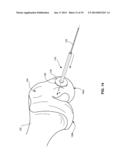 SYSTEM AND METHOD FOR JOINT RESURFACING AND REPAIR diagram and image