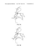 LITHOTRIPSY EYE TREATMENT diagram and image