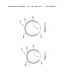 EXPANDABLE GUIDE EXTENSION CATHETER diagram and image