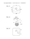 ENDOSCOPE TREATMENT TOOL diagram and image