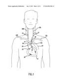 Occluding Catheter and Method for Prevention of Stroke diagram and image