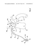 Occluding Catheter and Method for Prevention of Stroke diagram and image