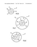 Occluding Catheter and Method for Prevention of Stroke diagram and image