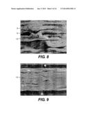 DEVICE AND METHOD FOR MANAGEMENT OF ANEURISM, PERFORATION AND OTHER     VASCULAR ABNORMALITIES diagram and image