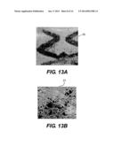 DEVICE AND METHOD FOR MANAGEMENT OF ANEURISM, PERFORATION AND OTHER     VASCULAR ABNORMALITIES diagram and image