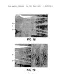 DEVICE AND METHOD FOR MANAGEMENT OF ANEURISM, PERFORATION AND OTHER     VASCULAR ABNORMALITIES diagram and image