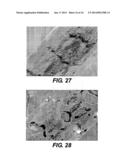 DEVICE AND METHOD FOR MANAGEMENT OF ANEURISM, PERFORATION AND OTHER     VASCULAR ABNORMALITIES diagram and image