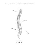 DEVICES AND METHOD FOR TREATMENT OF SPONDYLOTIC DISEASE diagram and image