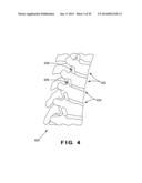 DEVICES AND METHOD FOR TREATMENT OF SPONDYLOTIC DISEASE diagram and image