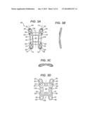 BENDING TOOL AND METHOD FOR RESHAPING A BONE PLATE diagram and image