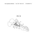 BENDING TOOL AND METHOD FOR RESHAPING A BONE PLATE diagram and image